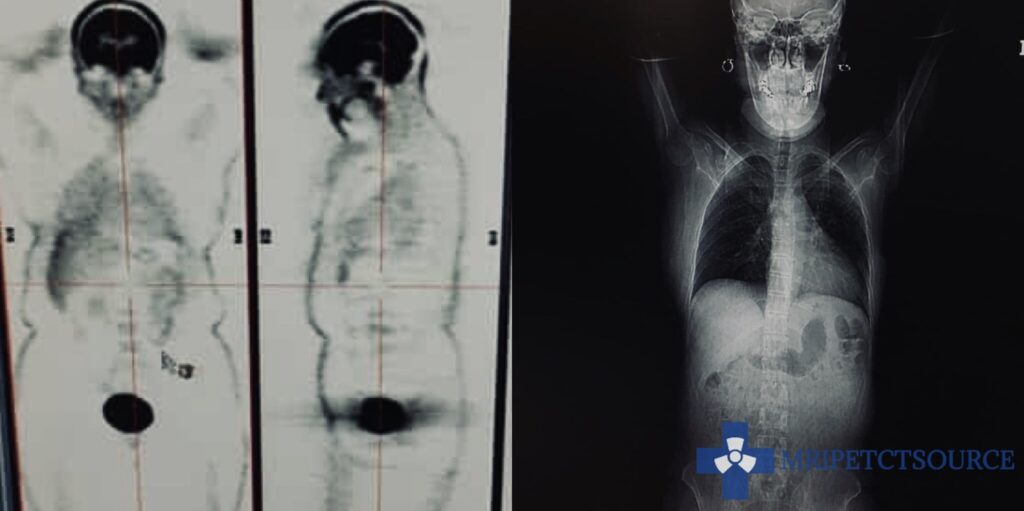 positron emission tomography Pet scan on left side and CT scan on right side