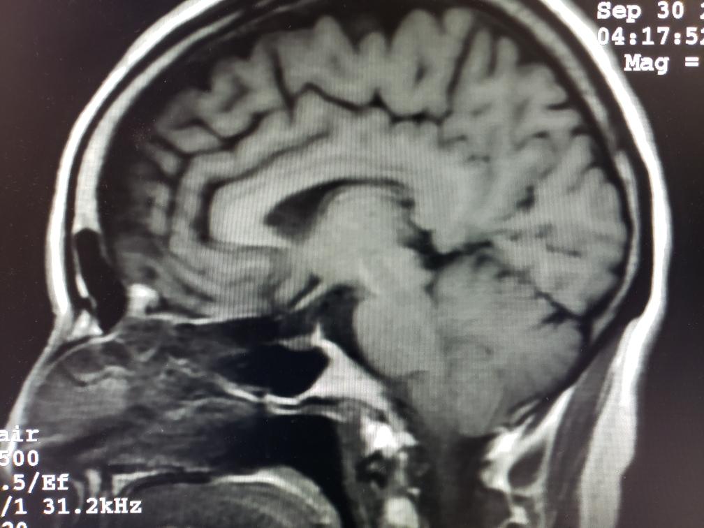 tips to stay calm during brain mri scan