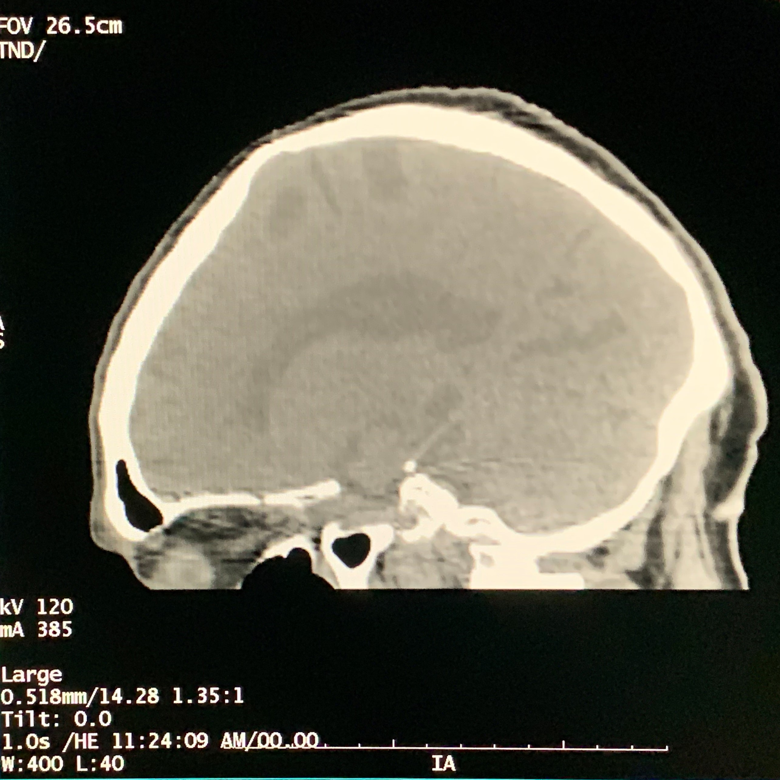 ct vs mri scan brain ct scan sagittal view