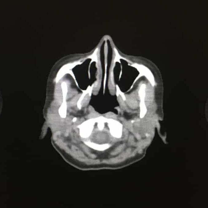 ct scan image, brain ct scan, what does a ct scan show, ct scan meaning, how does ct scan work, how ct scan works, what is ct scan used for, how do ct scans work, what is the purpose of a ct scan, ct scan overview, what does ct scan show, what does a ct scan do, c t scan means, ct scan procedure, how a ct scan works, ct scanner, how ct scan is done, how does ct work, ct scan how does it work, ct scans, ct scan how does it work, ct scan how it works, how does computed tomography work, how does a ct scanner work, ct scan process, how ct works, define ct scan, whats a ct scan, ct how it works, how does a cat scan work, how does ct scans work, purpose of ct scan, ct scan what is it used for