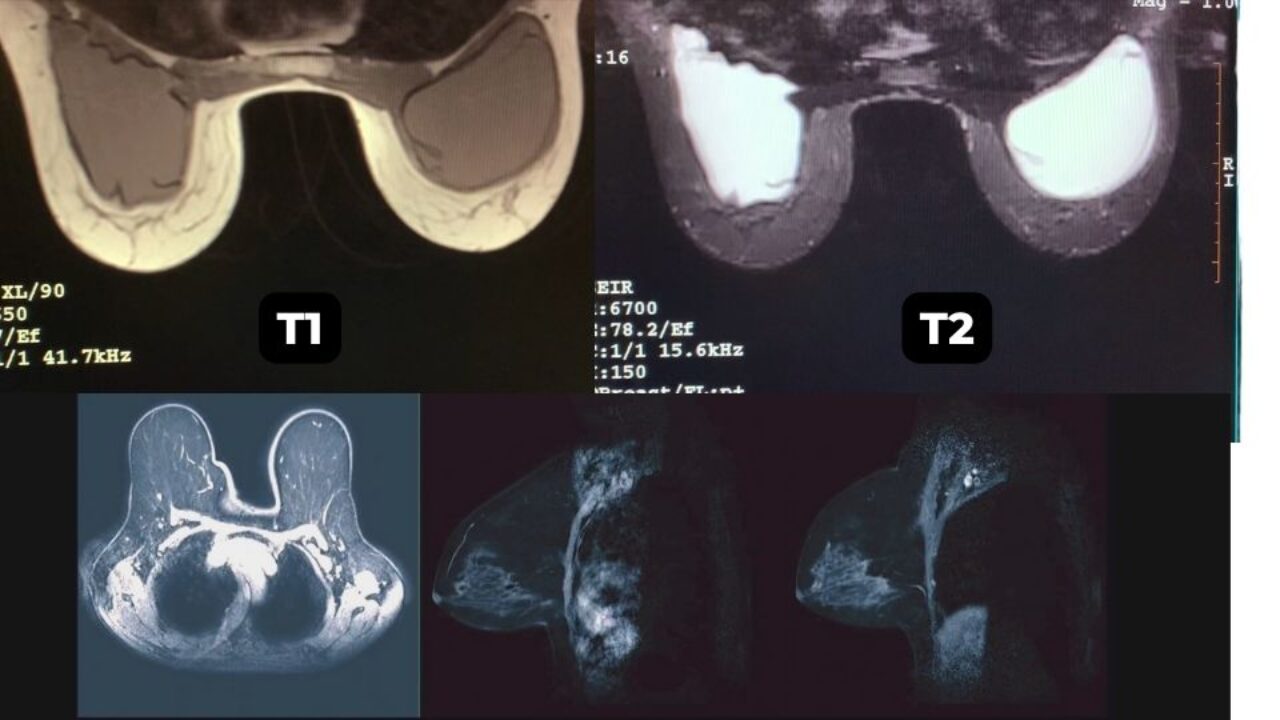 健康・医学 Breast MRI T1-vs-T2-Breast-MRI-Scan-