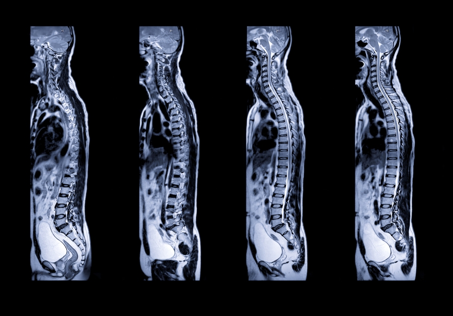 lumbar mri spine examples featured image thumbnail