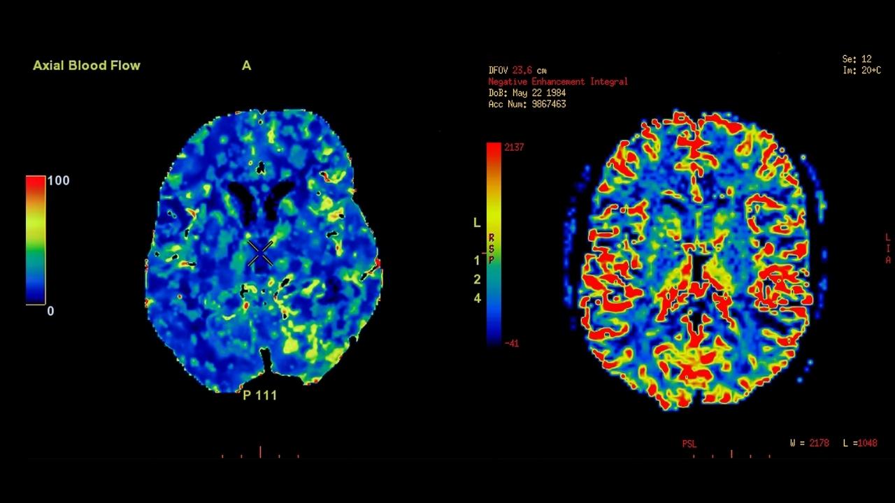 pet scan images, brain pet scan, pet scan brain
