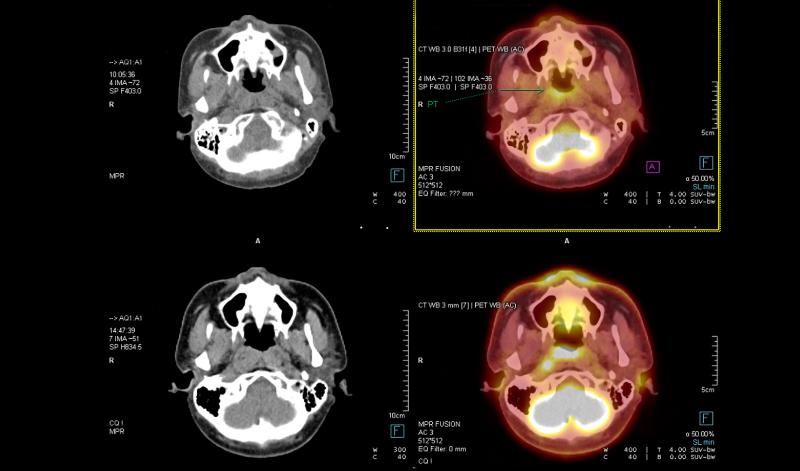 pet scan images, brain pet scan, pet scan brain