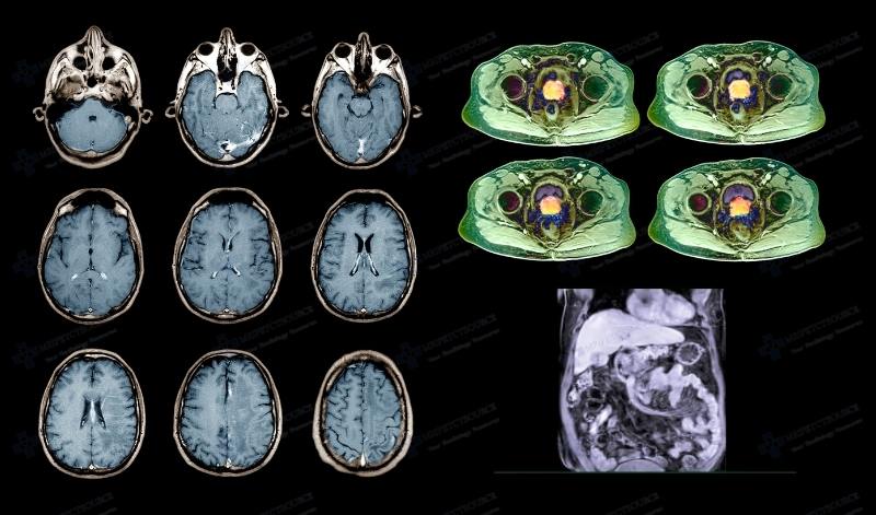 gadolinium, gadolinium based contrast agents, GBCA, GBCAs, mri contrast agents, images of mri contrast, mri contrast images