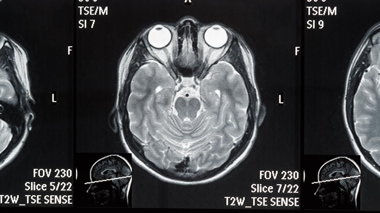 mri scan parameters, mri scan parameters tradeoffs, mri T2 scan