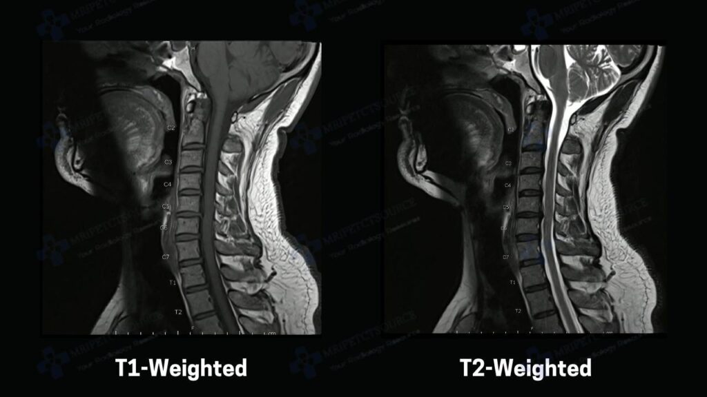 T1 vs T2 MRI, t1 vs t2 mri, t2 vs t1 mri, mri t2 vs t1, mri t1 vs t2, mri scan images