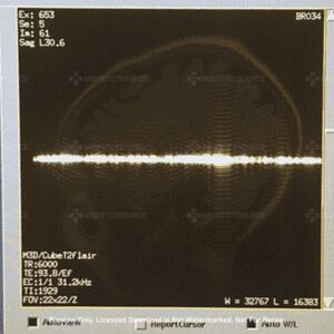 Brain MRI Artifact